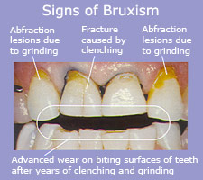 Signs of
    Bruxism