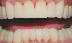 Restoration of front teeth using laminates - Dentistry by Dr. Dean
    Sophocles