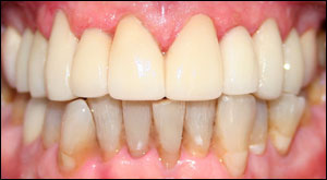 Restoration of upper teeth using laminates - Dentistry by Dr. Dean Sophocles