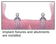 Implant-supported denture
