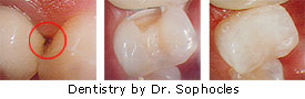 Cavity on side of tooth, direct resin restoration - Restorative Dentistry by Dr. Dean Sophocles