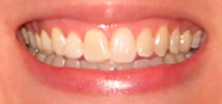 Bride's smile after bleaching
