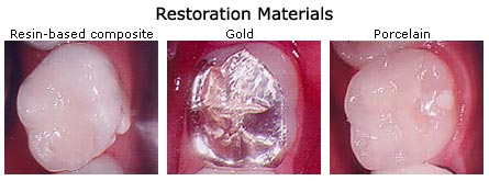 Examples of Restoration Materials